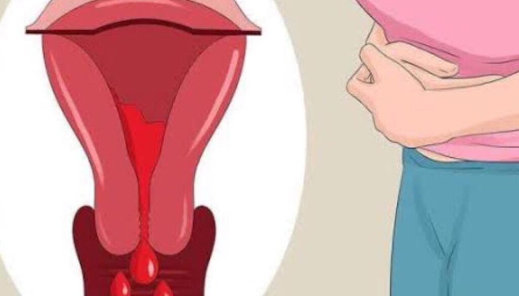 Anormal Rahim (Uterin) Kanaması Nedir?