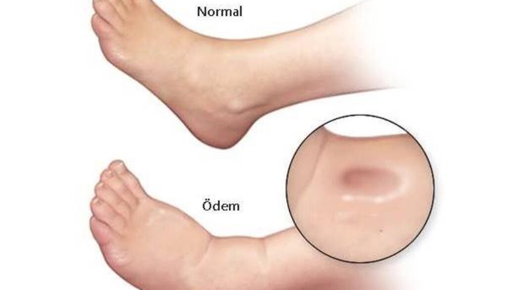 Ödem