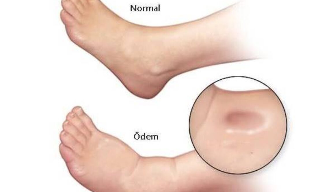Ödem