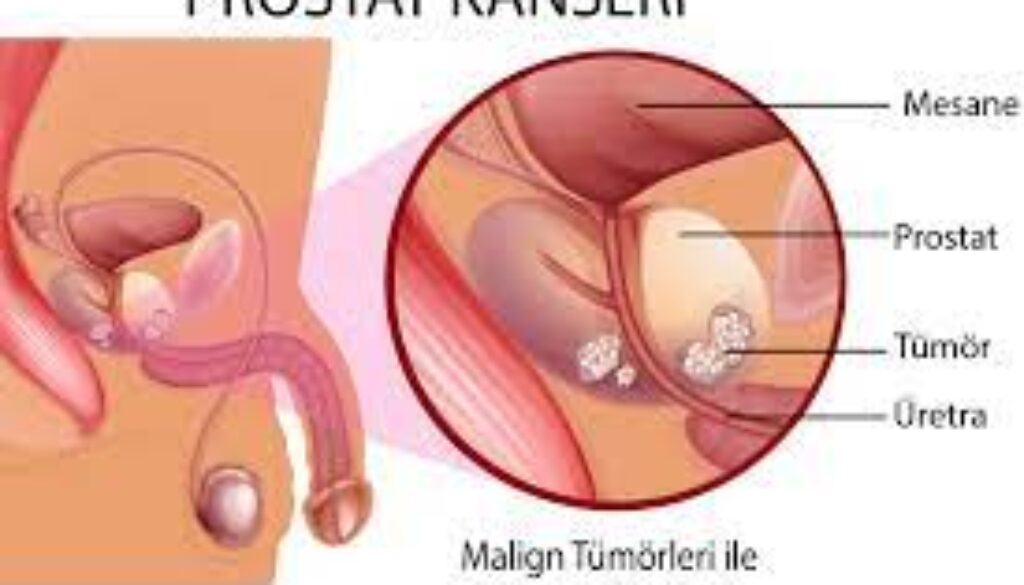 Prostat Kanseri Nedir?