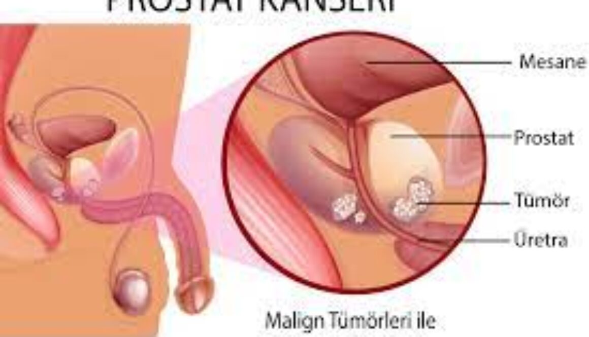 Prostat Kanseri Nedir?