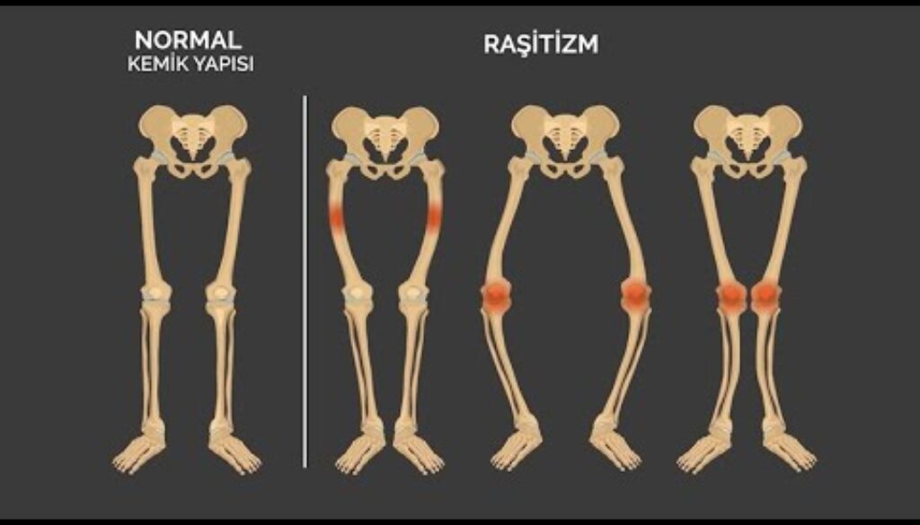 Raşitizm nedir?