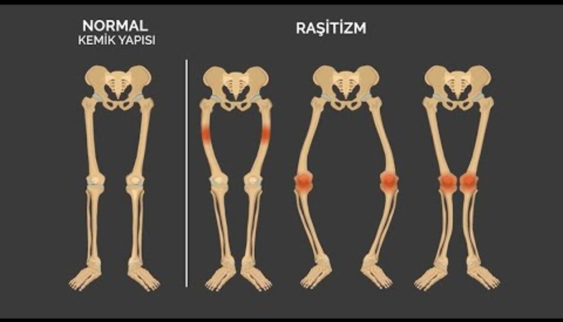 Raşitizm nedir?