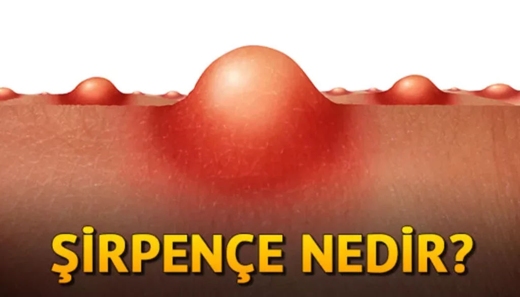 ŞİRPENÇE (ASLAN PENÇESİ) NEDİR?