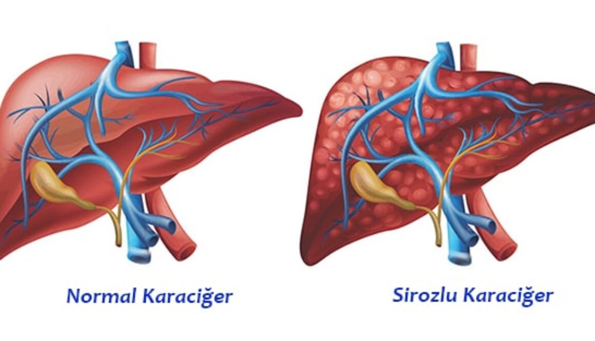 Siroz nedir?