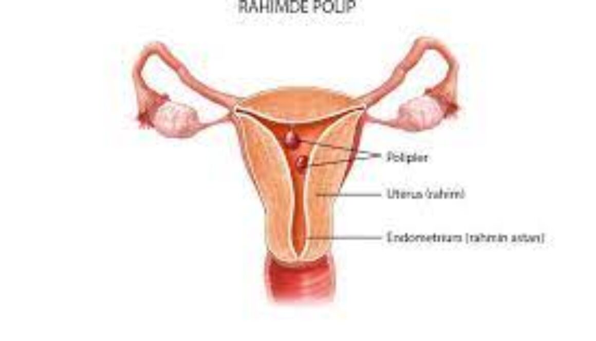 rahimde polip