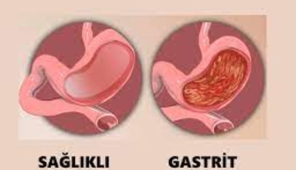 Gastrit