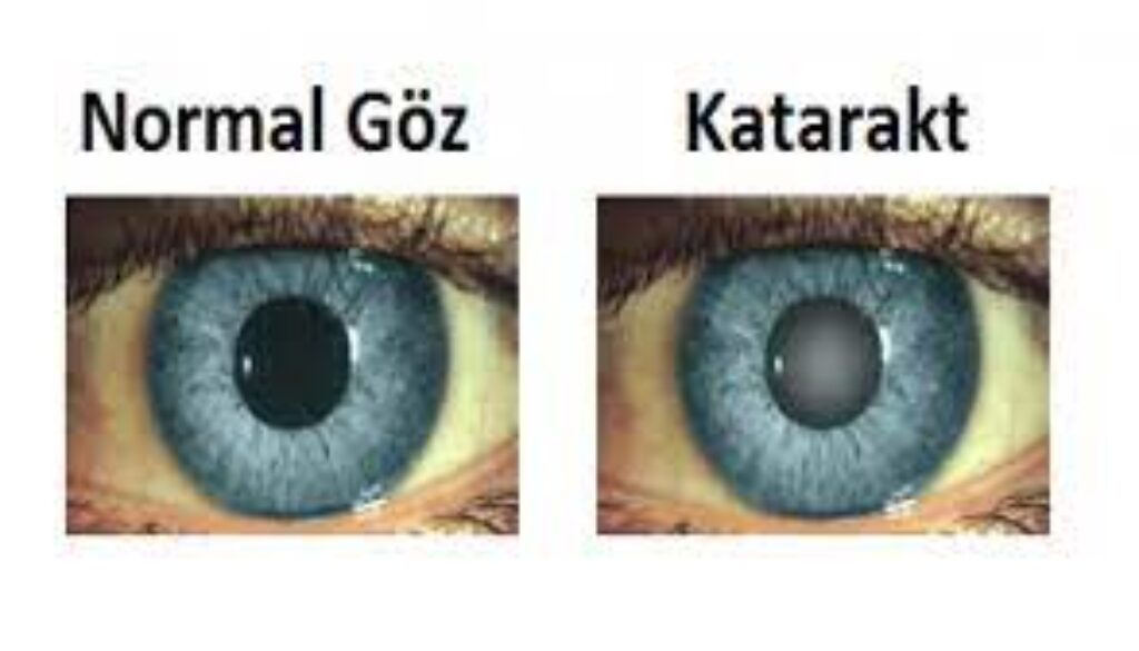 Katarakt
