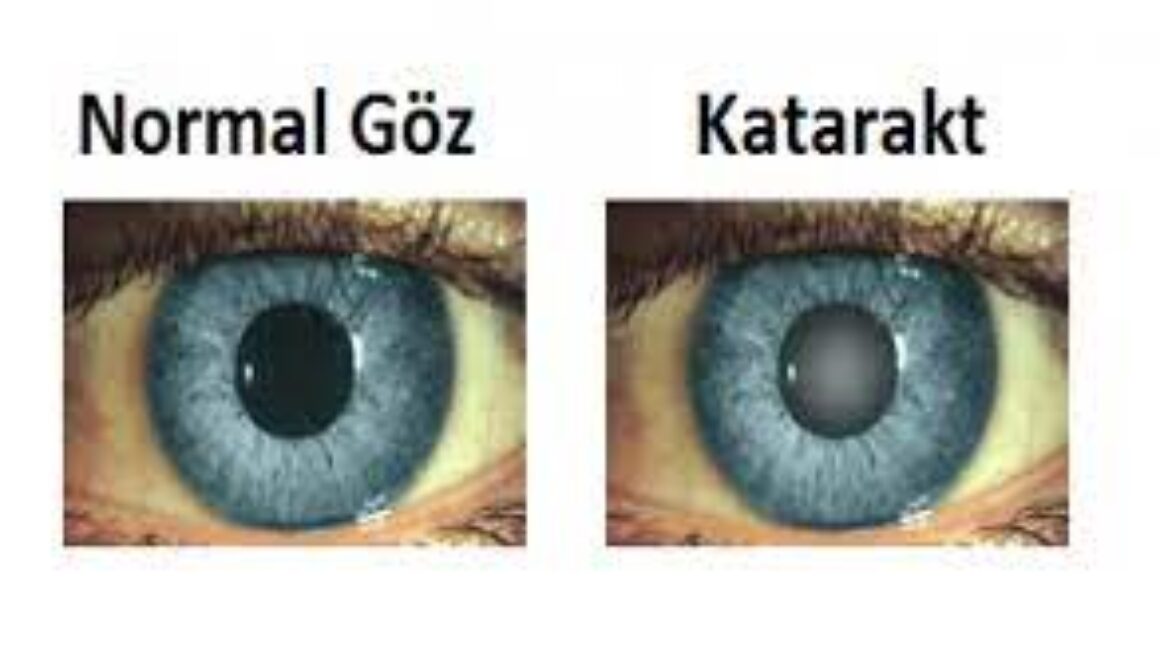 Katarakt