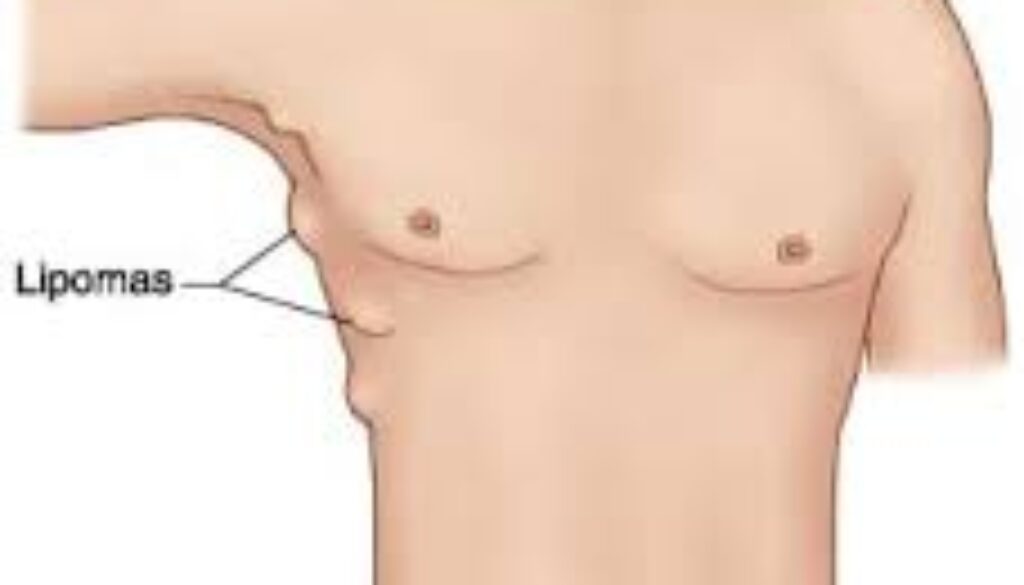 Lipom Lipom