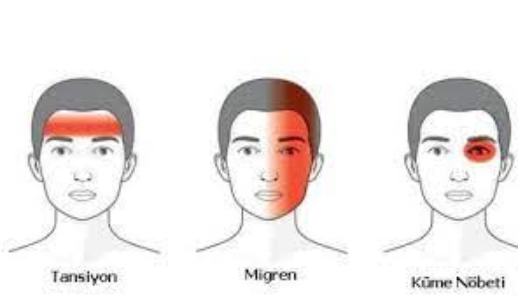Migren