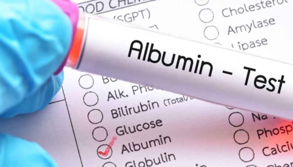 Albüminüri